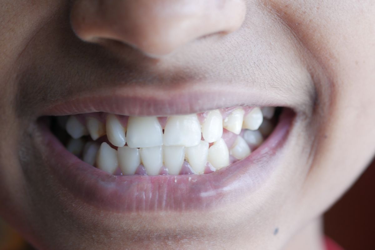 Preventing enamel erosion on teeth