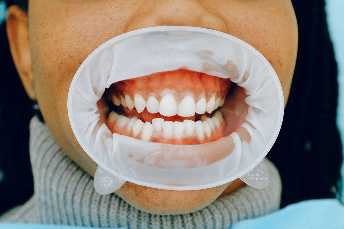 Early signs of gum disease